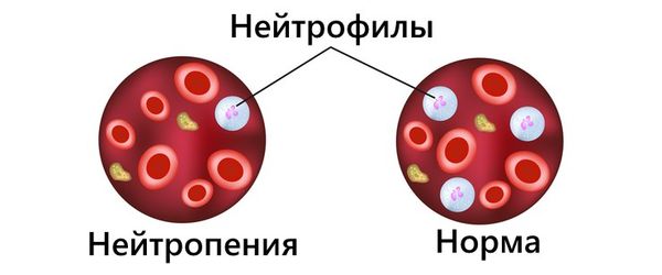 Нейтропения