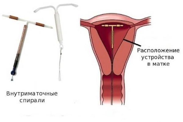 Внутриматочная спираль