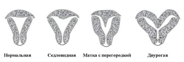 Пороки развития матки