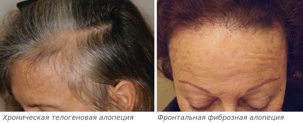 Виды алопеции