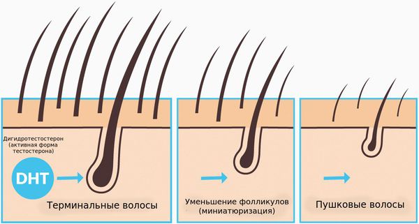 Превращение терминальных фолликулов в веллусоподобные