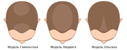 Модели андрогенетической алопеции