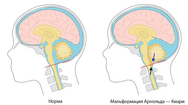 Мальформация Арнольда — Киари. Смещение миндалин (чёрная стрелка) в каудальном направлении (синяя стрелка) ниже плоскости большого затылочного отверстия (красная линия).