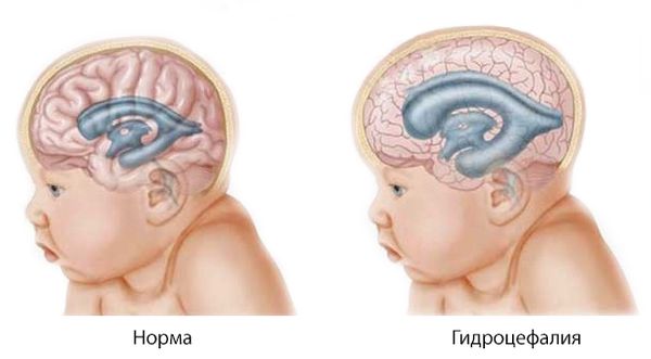 Гидроцефалия
