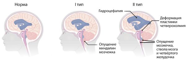 Мальформация Киари I и II типа