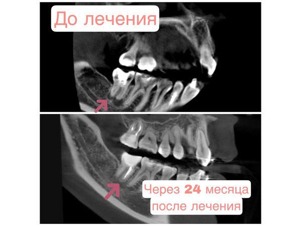 Результата лечения через 2 года