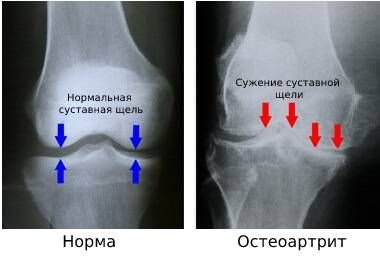 Сужение суставной щели при остеоартрите 