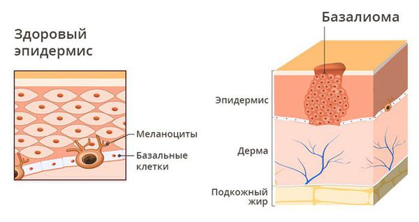 Базальноклеточный рак