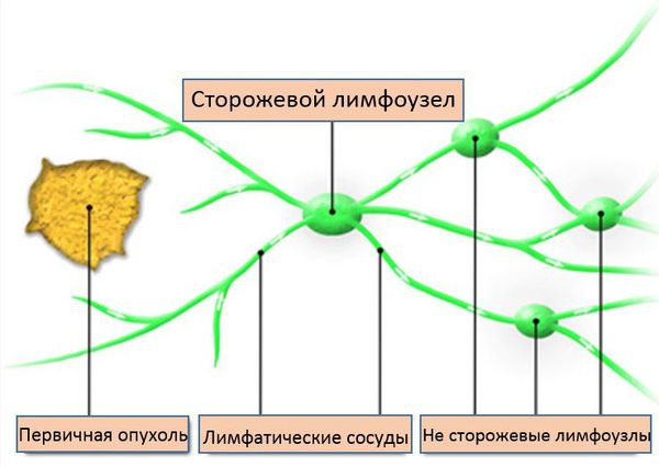 Сторожевой лимфоузел