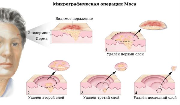 Микрографическая операция по системе Моса