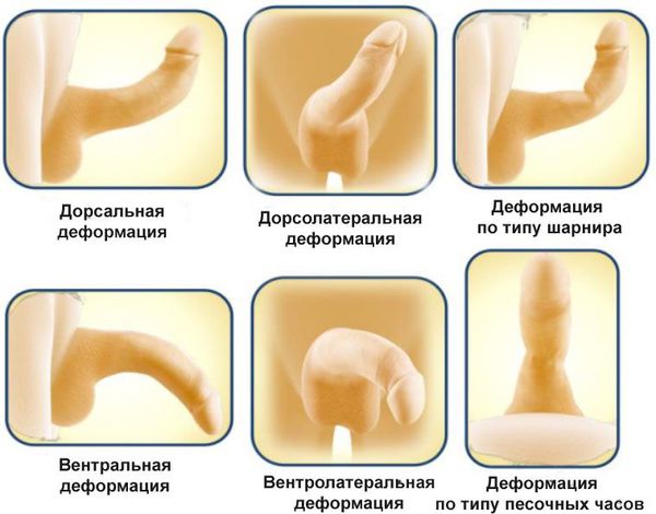 Виды деформации полового члена