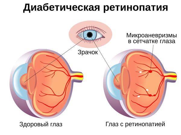 Признаки диабетической ретинопатии
