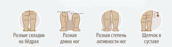 Симптомы врожденного вывиха бедра