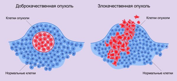 Доброкачественная и злокачественная опухоль