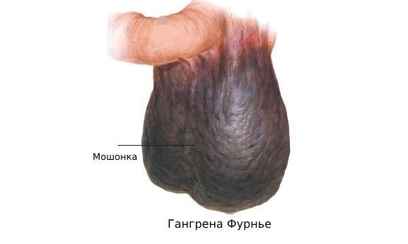 Гангрена Фурнье' data-blur='False