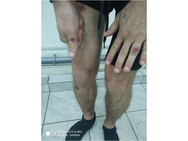 Множественные высыпания на руках и ногах