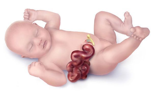 Выпадение петель кишечника через дефект в брюшине