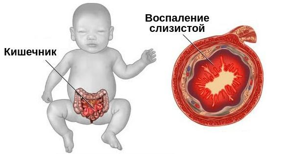 Энтероколит