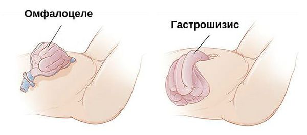 Омфалоцеле и гастрошизис