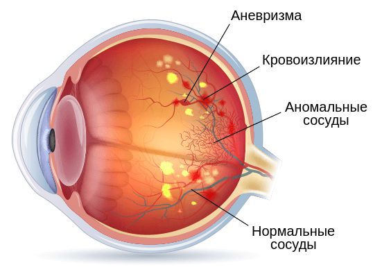 Диабетическая ретинопатия