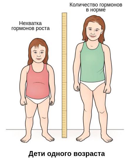 Отставание в росте