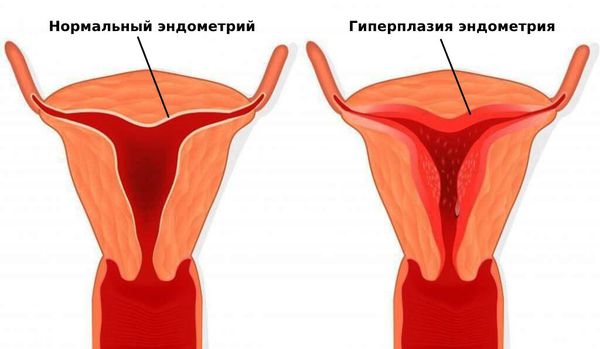 Гиперплазия эндометрия