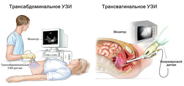 УЗИ органов малого таза