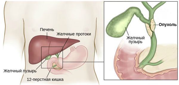Опухоль желчных протоков