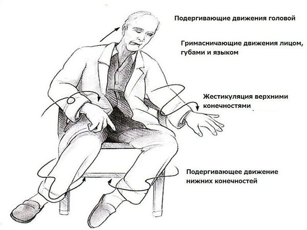 Хореические гиперкинезы