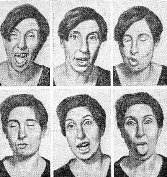 Гиперкинезы языка, мягкого нёба, губ