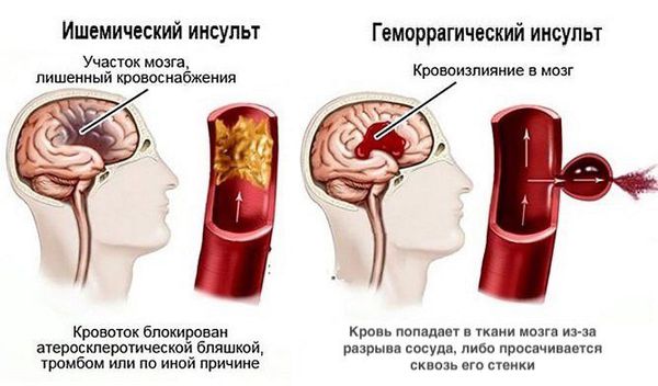 Инсульт ишемический и геморрагический