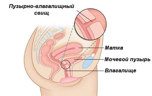 6 предметов, которые не должны попасть во влагалище