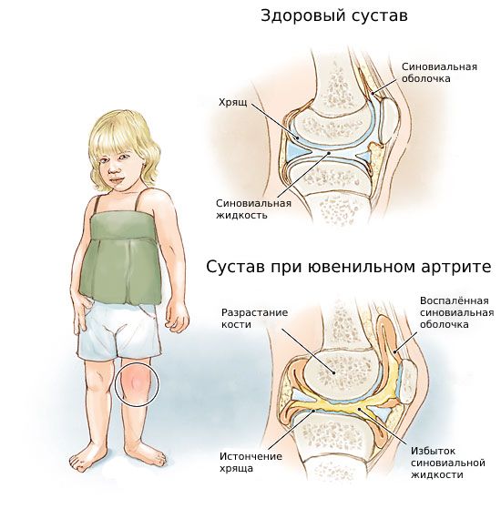 Ювенильный идиопатический артрит