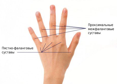 Пястно-фаланговые и проксимальные межфаланговые суставы