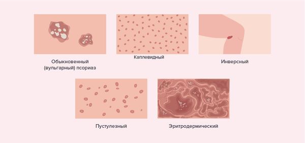 Виды псориаза