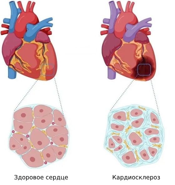 Кардиосклероз