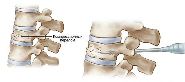 Выполнение вертебропластики