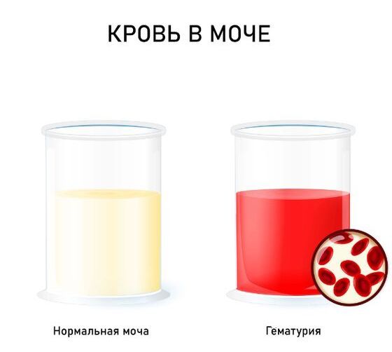 Гематурия