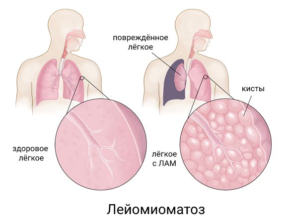 Лейомиоматоз 