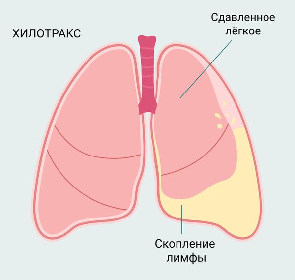 Хилотракс