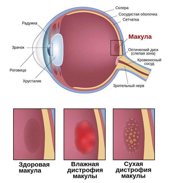 Макулярная дегенерация