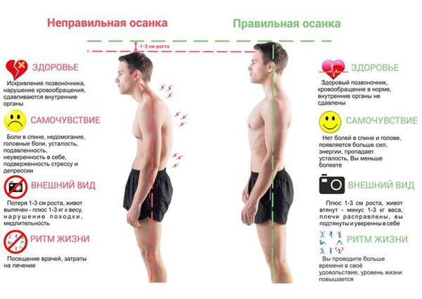 Симптомы нарушения осанки