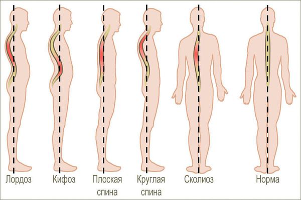 Классификация нарушений осанки