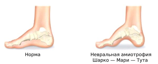 Невральная амиотрофия Шарко — Мари — Тута