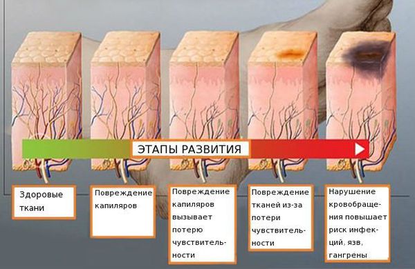 Диабетическая полинейропатия 