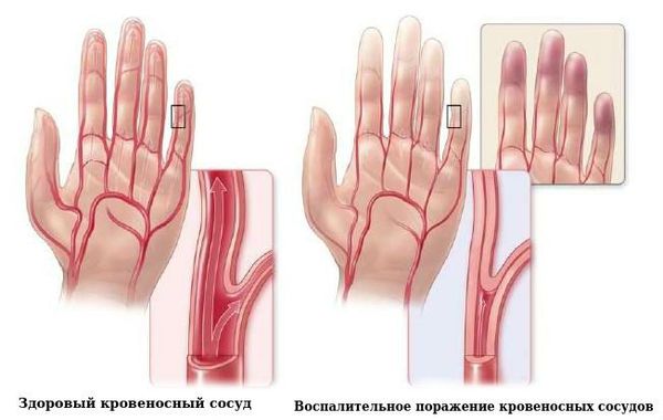 Воспалительное поражение кровеносных сосудов