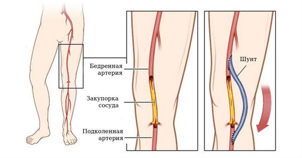 Бедренно-берцовое шунтирование