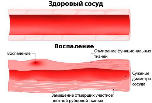 Воспаление кровеносного сосуда