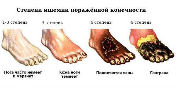 Степени ишемии поражённой конечности