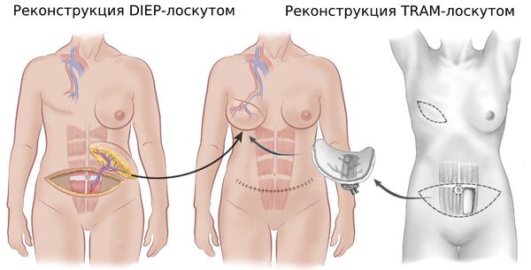 Реконструкция лоскутами DIEP и TRAM